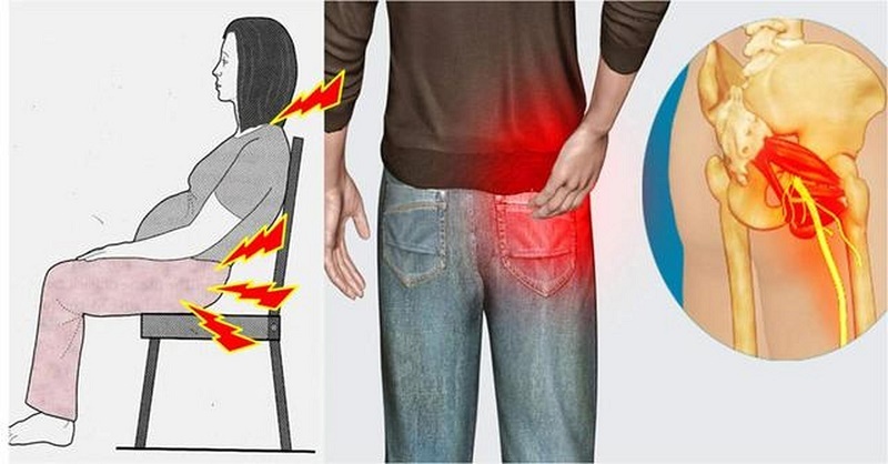 How to Relieve The Sciatica?