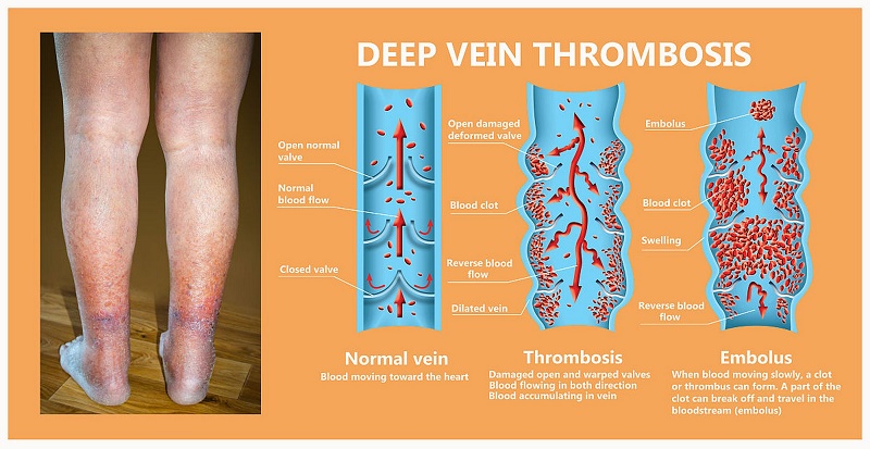 How to Prevent and Treat The Venous Thrombosis?